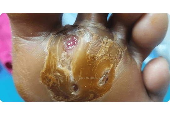 After - Diabetic Foot