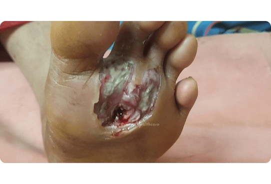 Before - Diabetic Foot